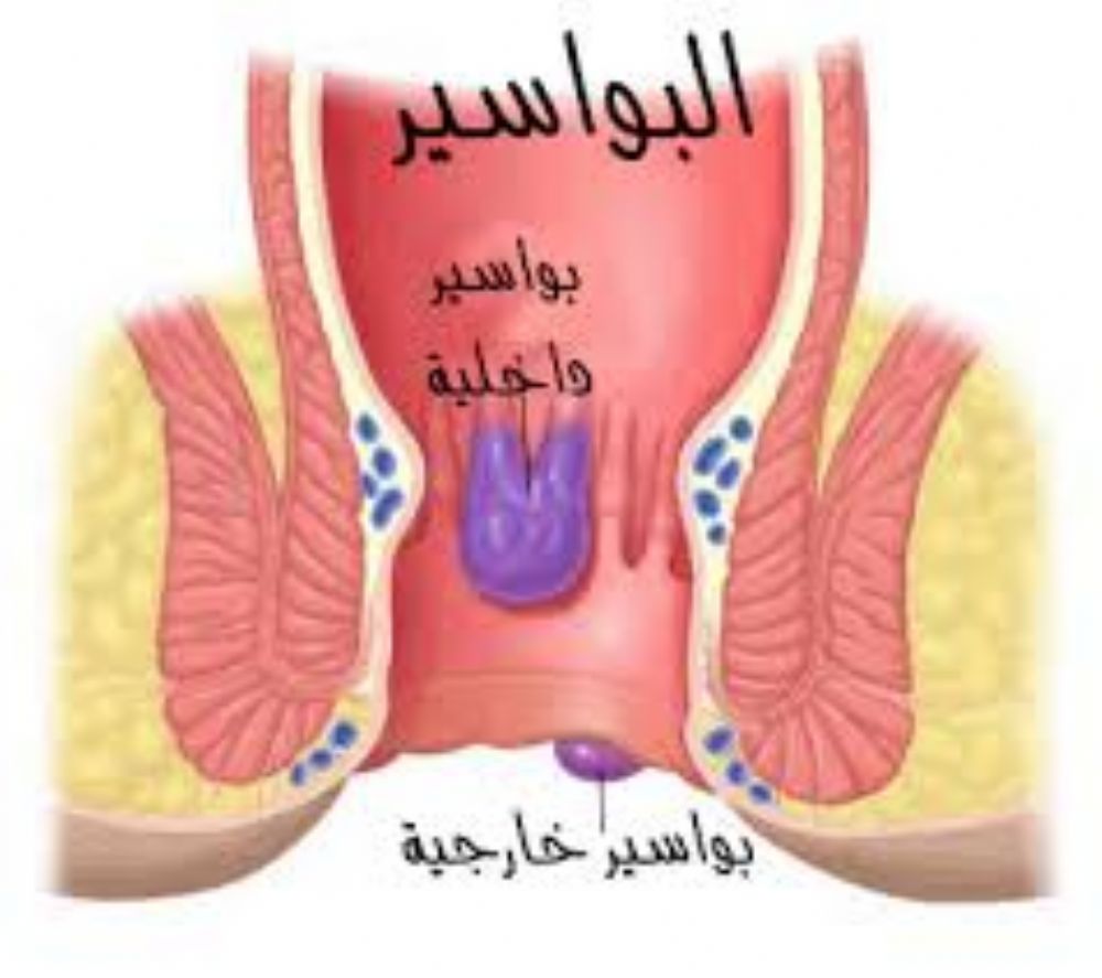 كيف يكون شكل البواسير , البواسير من اكثر الامراض انتشار ا