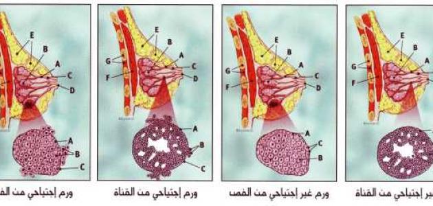 اعراض سرطان الثدي الحميد بالصور , هل تتشابه اعراض الورم الحميد و الخبيث