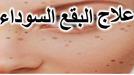 البقع الداكنة في الجسم،كيفيه التخلص من سواد الركب و الكوع 8391 3