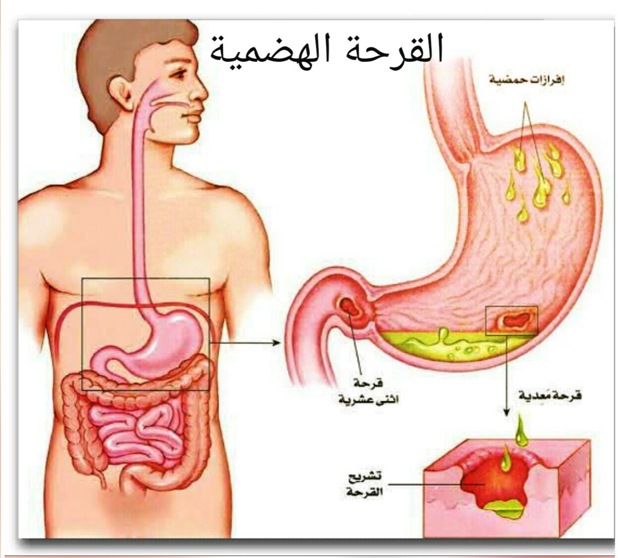 اعراض قرحة المعدة - كيفيه التخلص من الامراض الشائعه 5801 2