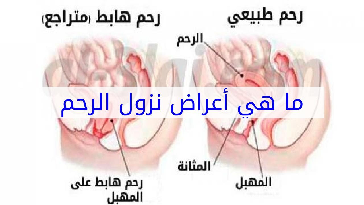 علاج نزول الرحم , كيفيه الوقايه من نزول الرحم