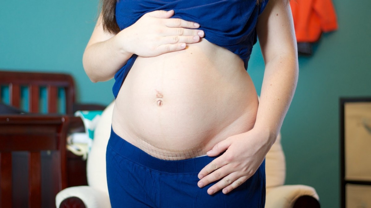 5906 1 العناية بالجسم بعد الولادة القيصرية - كيف اهتم بجسمي بعد الولاده القيصريه تليد خلف